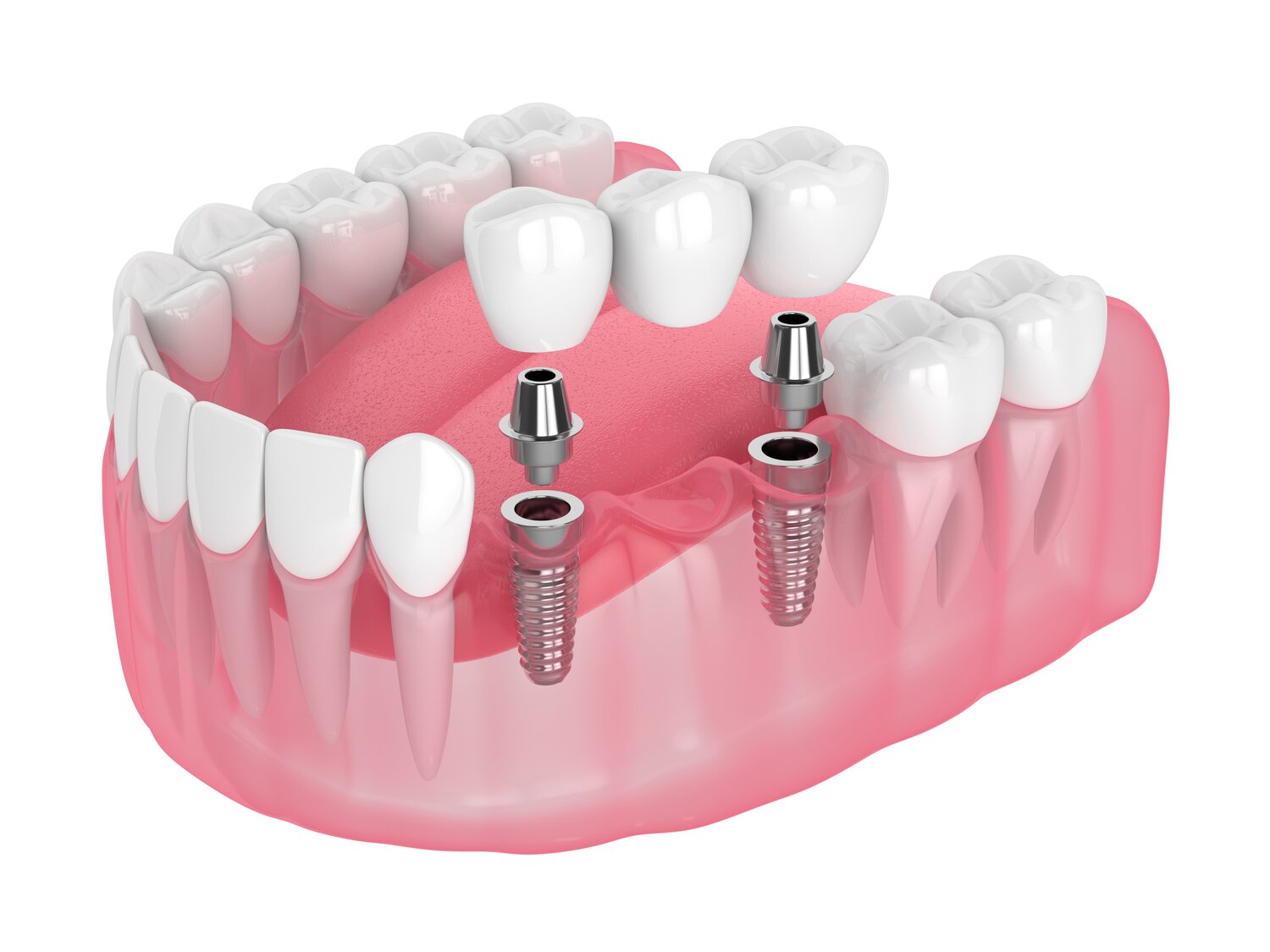 Model implantów zębowych